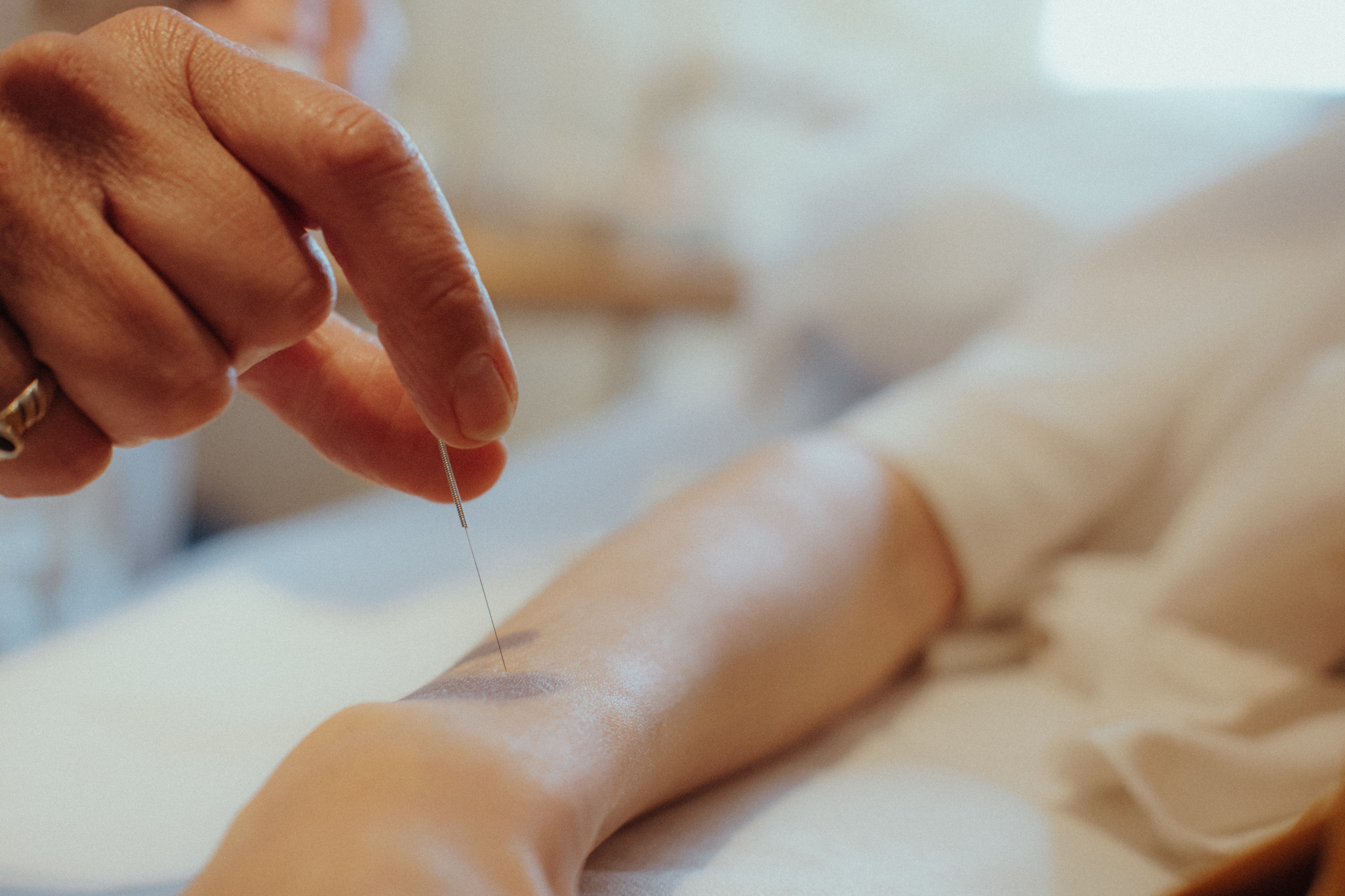 Acupuntura